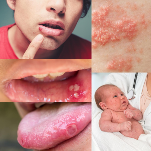 Herpes on Various Parts of the Body