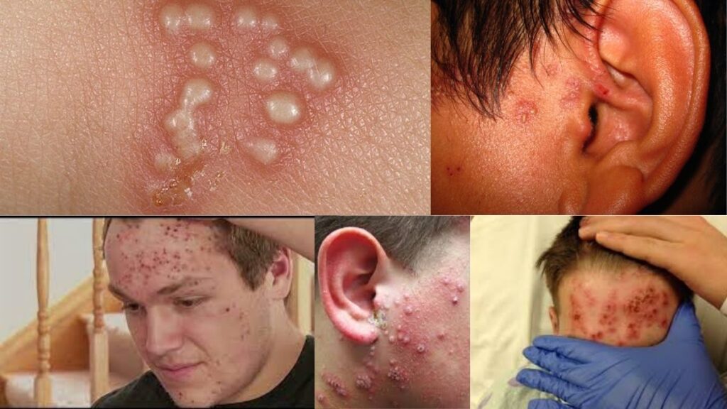 The infection of Gladiatorum Herpes is very similar to Oral Herpes